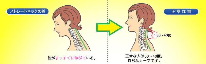 最近多いストレートネック型肩こり